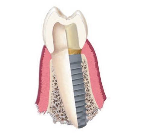 Advanced Periodontal Therapies