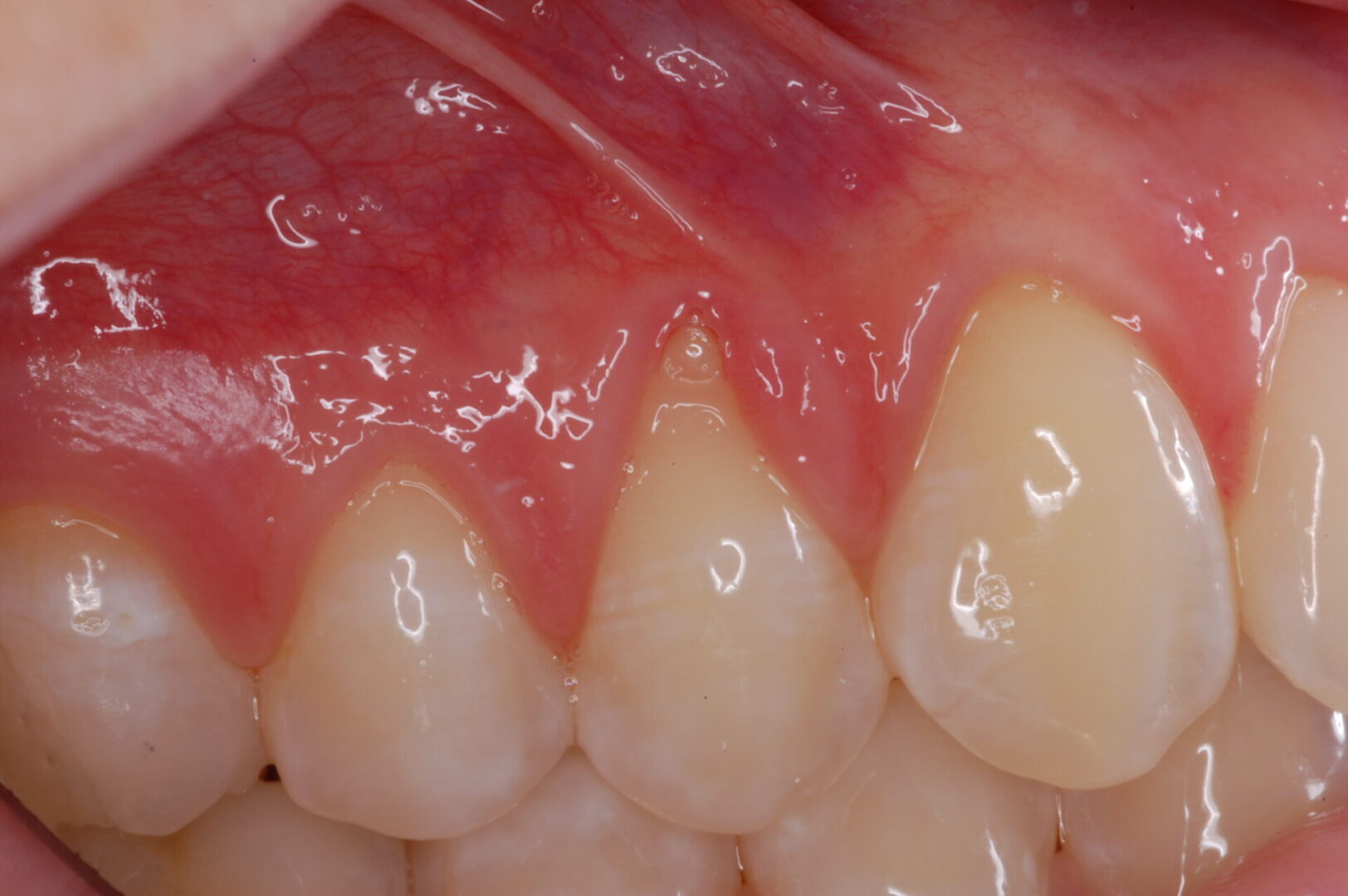 Before Gingival Recession